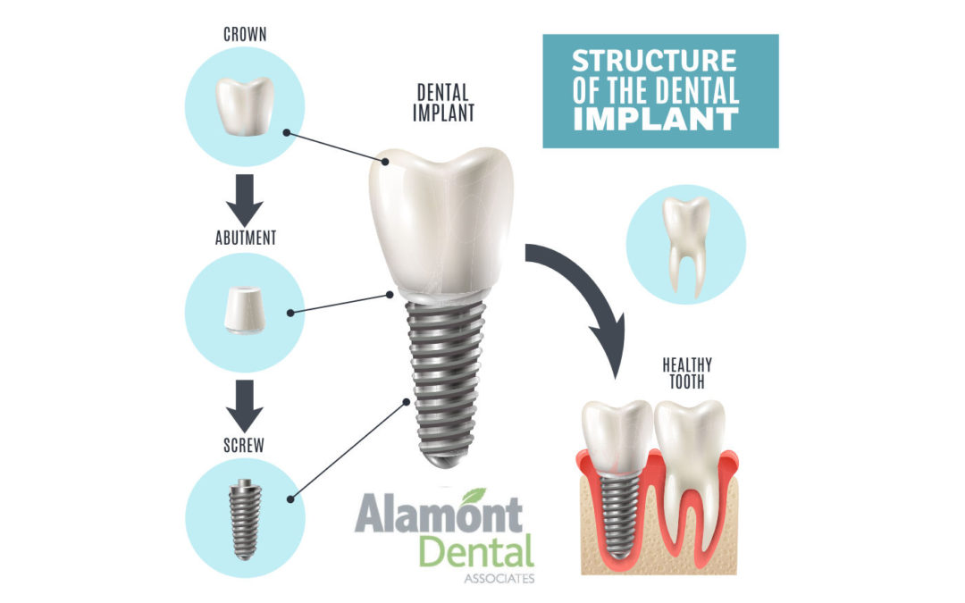 dental implant overview - alamont dental associates - bristol tn