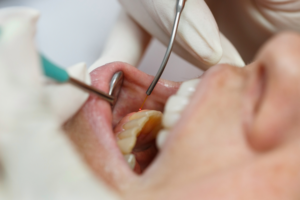 periodontal laser gum treatment - alamont dental associates